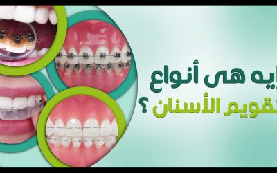 انواع تقويم الاسنان | د/ مصطفي الشيتي