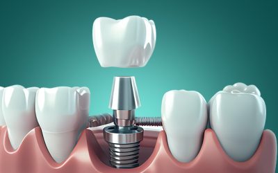 أكتر 13 سؤال شائع عن تركيبات الأسنان وإجابات الدكاترة المتخصصين