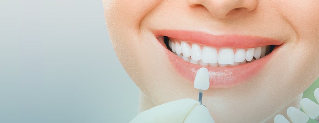 الفرق بين تبييض الاسنان وهوليود سمايل
