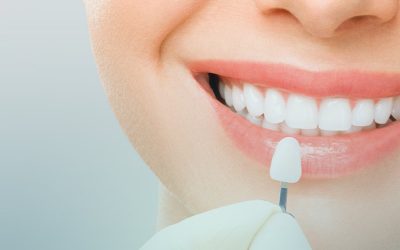 الفرق بين تبييض الاسنان وهوليود سمايل