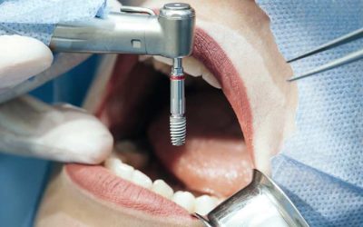 مراحل زراعة الاسنان وأهم نصائح في كل مرحلة